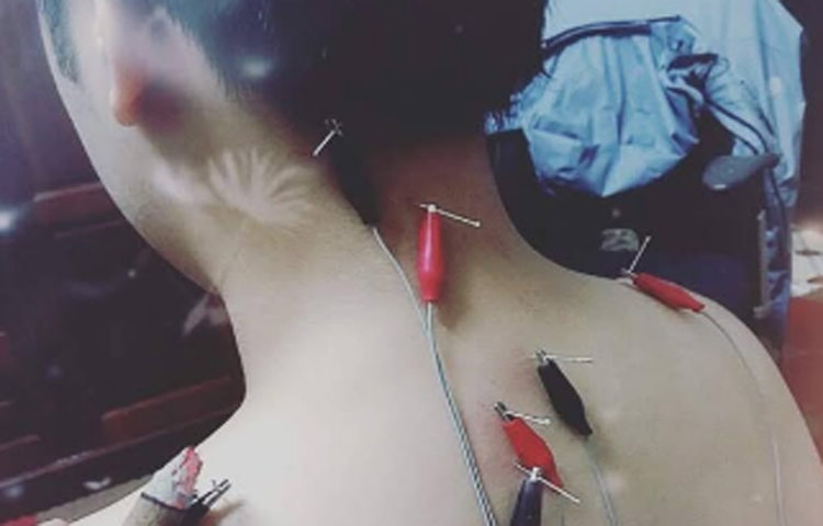 Điện châm điều trị tổn thương rễ, đám rối dây thần kinh (Chứng nuy)